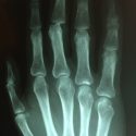 Orthopaedic / Hand Case Study (Katriona Buhler)